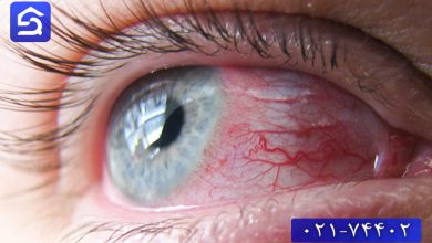 تصویر درمان سوختگی چشم با اسید
