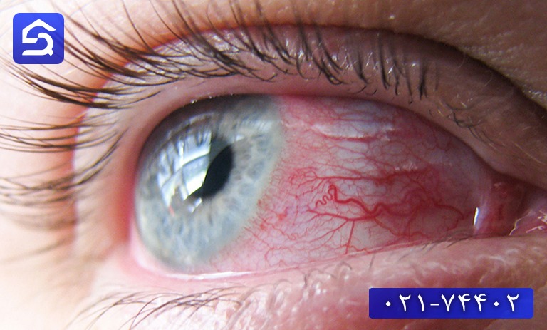 درمان سوختگی چشم با اسید