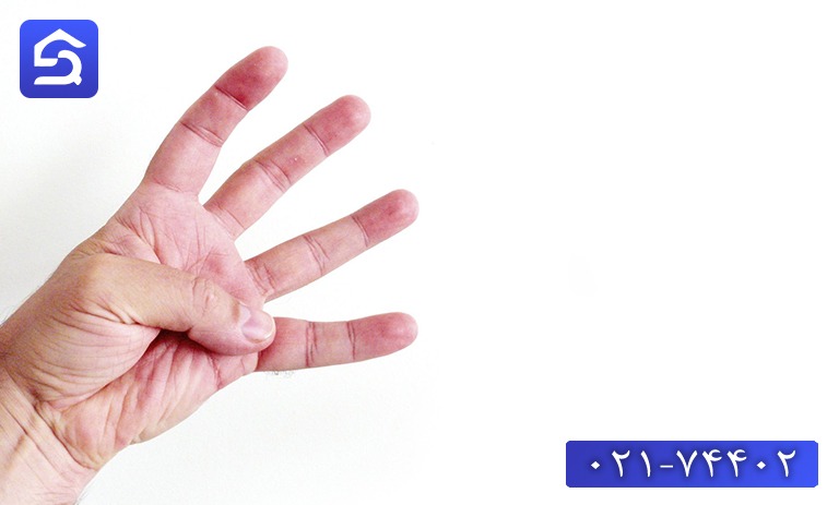 درمان سوختگی انگشت دست