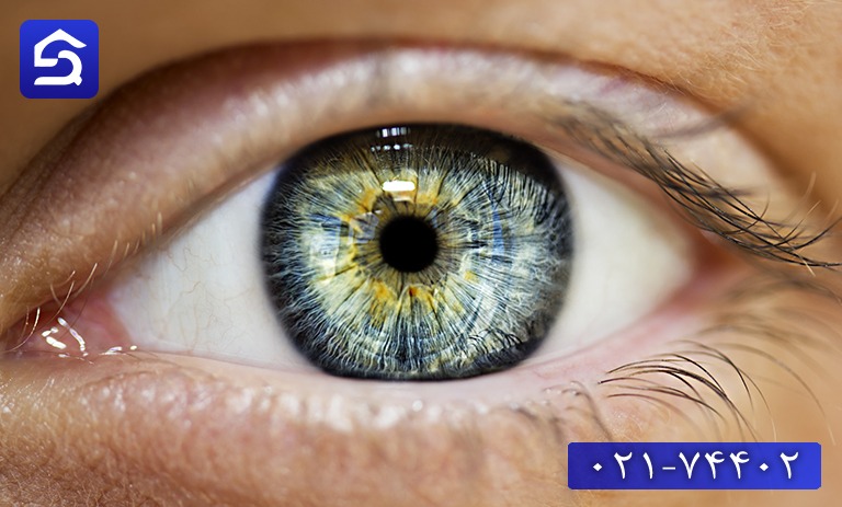 درمان سوختگی قرنیه چشم