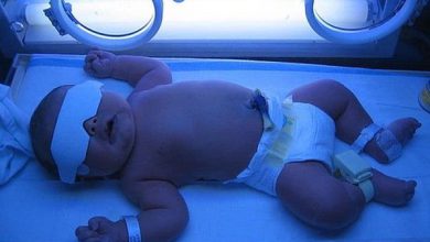 تصویر درمان زردی نوزاد در منزل